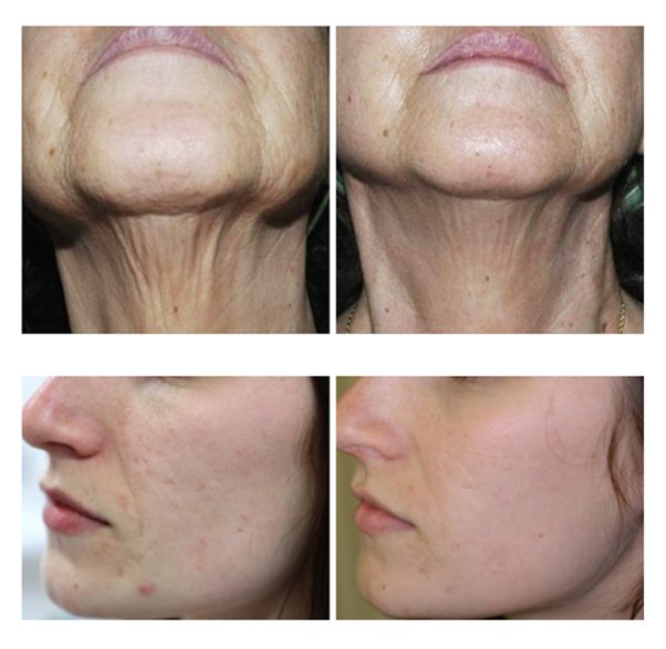 ublative, Sublative treatment, sublative treatment before and after
