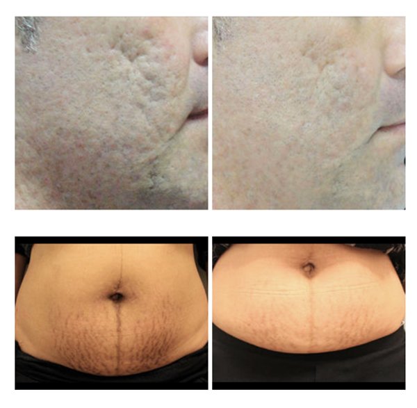 ublative, Sublative treatment, sublative treatment before and after